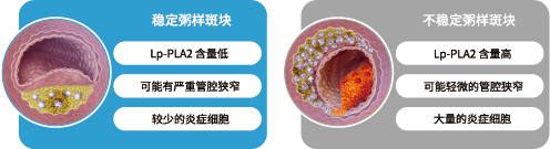 脂蛋白磷脂酶A2和全程C-反应蛋白联合检测试剂盒(微球免疫层析法)